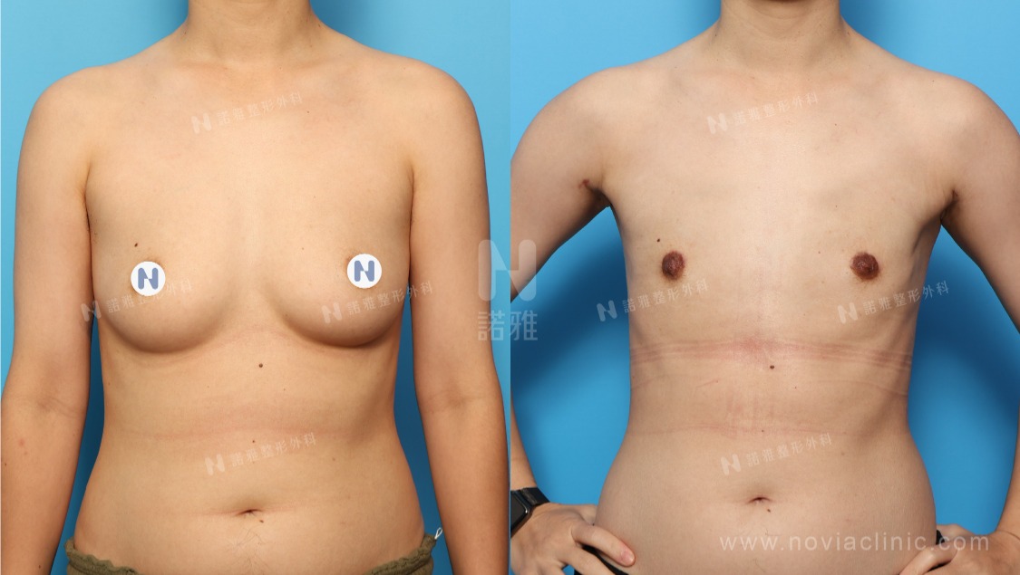 微創平胸手術案例