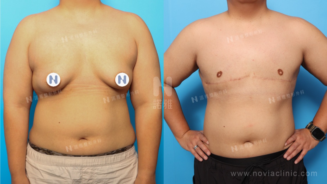 一字型平胸手術案例