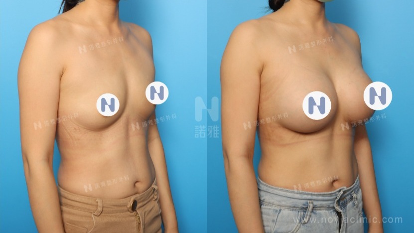 諾雅魔滴隆乳手術美麗見證案例