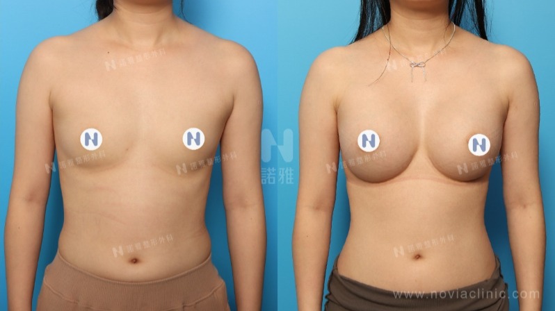 諾雅隆乳手術｜隆乳的優點，內視鏡隆乳手術前後對比照。