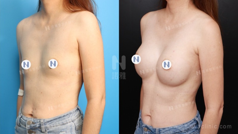 諾雅隆乳手術｜隆乳的優點，內視鏡隆乳手術前後對比照。