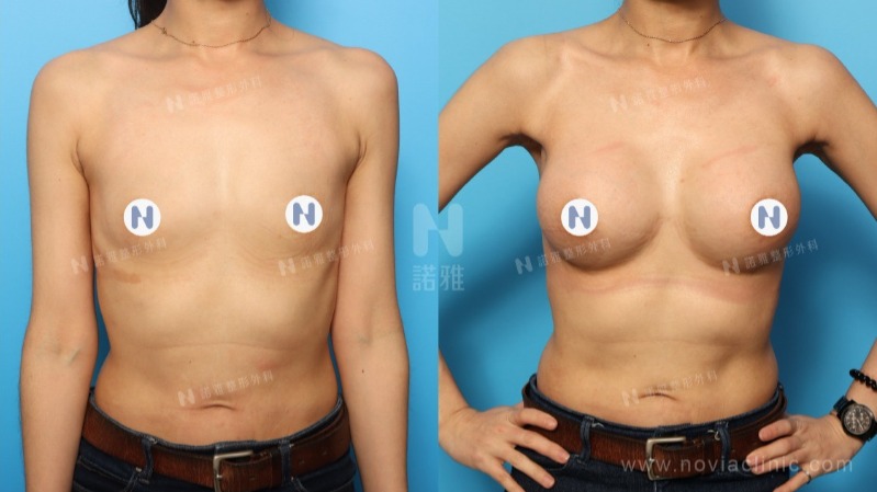 諾雅隆乳手術｜美麗見證案例，果凍矽膠隆乳手術前後，成功案例對比照片。