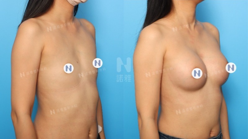 諾雅隆乳手術｜隆乳原理介紹，內視鏡隆乳案例，手術前後對比照。