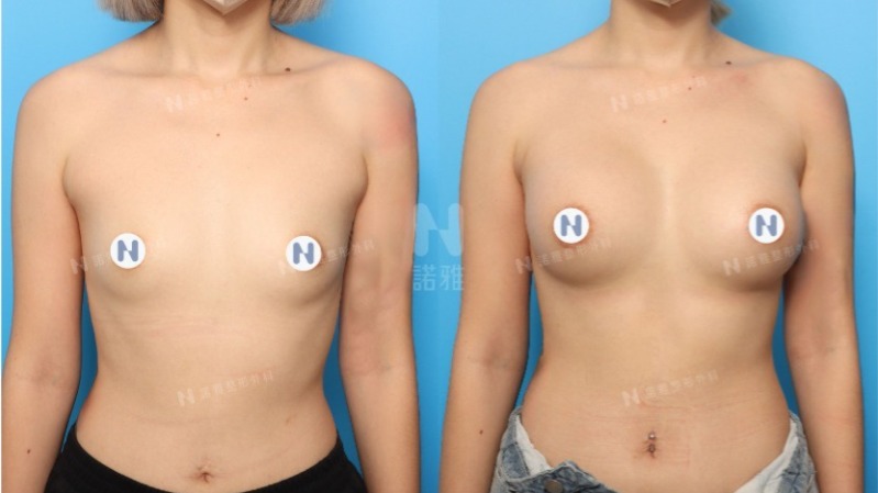 諾雅隆乳手術｜隆乳原理介紹，內視鏡隆乳案例，手術前後對比照。