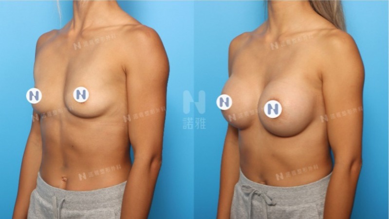 諾雅隆乳手術｜隆乳的優點，內視鏡隆乳手術前後對比照。