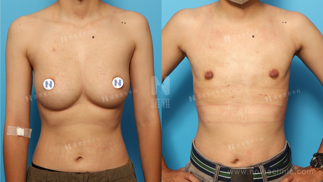 微創平胸手術案例