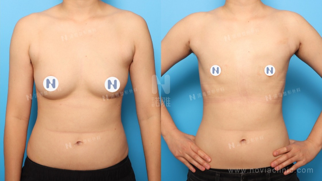 微創平胸手術案例