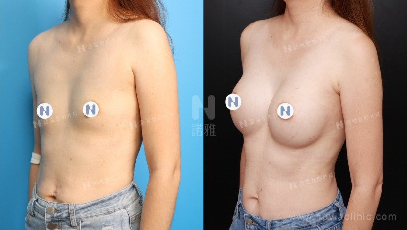 諾雅魔滴隆乳手術美麗見證案例
