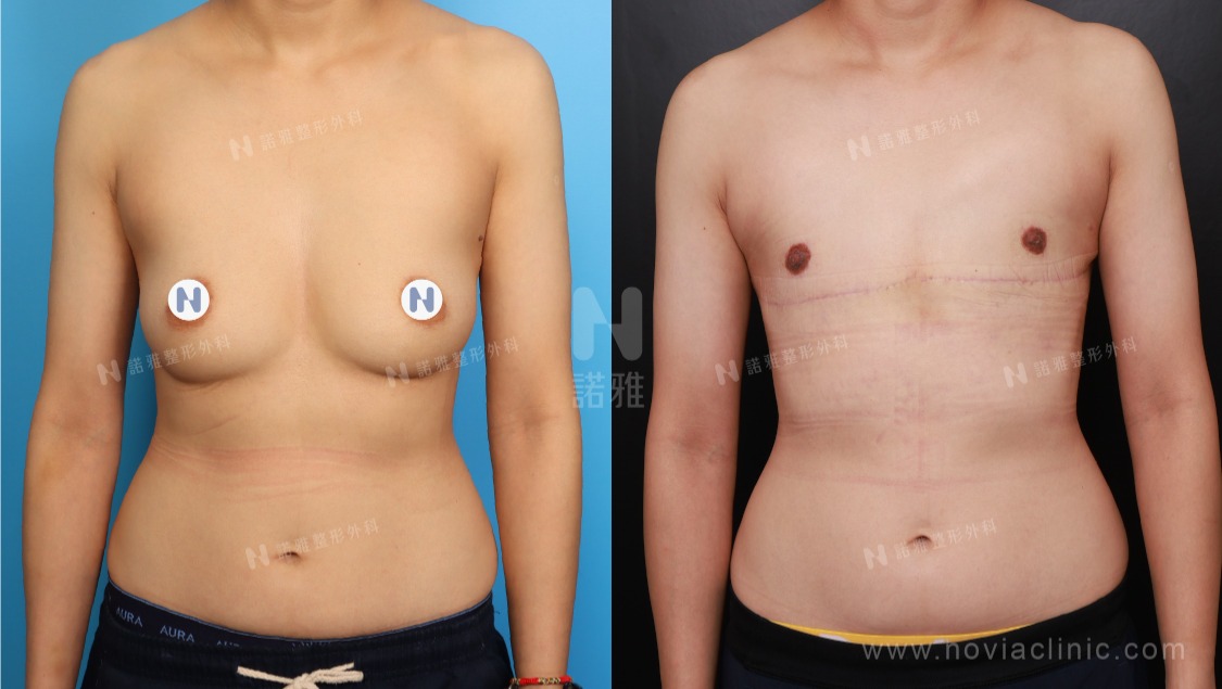 一字型平胸手術案例