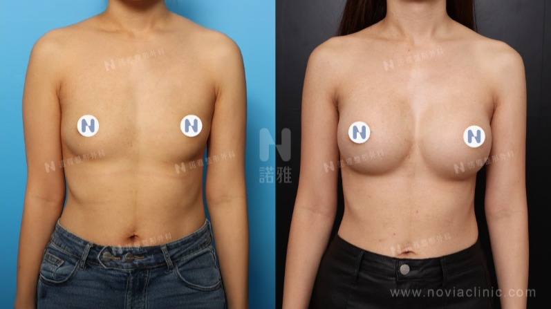 諾雅隆乳手術｜隆乳原理介紹，內視鏡隆乳案例，手術前後對比照。