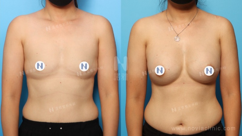 諾雅隆乳手術｜美麗見證案例，手術前後對比照。