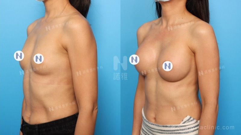 諾雅隆乳手術｜美麗見證案例，手術前後對比照。