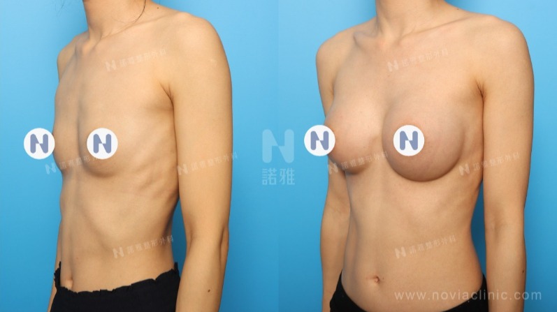 諾雅隆乳手術｜隆乳原理介紹，內視鏡隆乳案例，手術前後對比照。