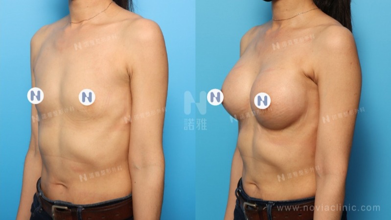 諾雅專業整形外科｜美麗見證案例，果凍矽膠隆乳手術前後對比照片。