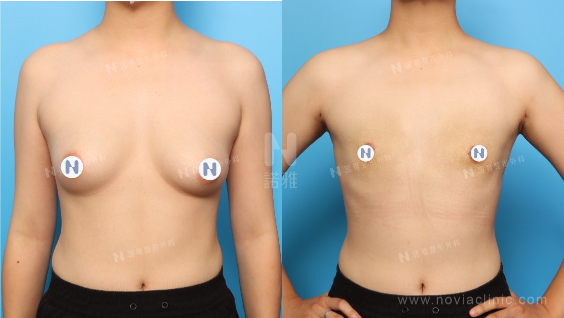 微創平胸手術案例