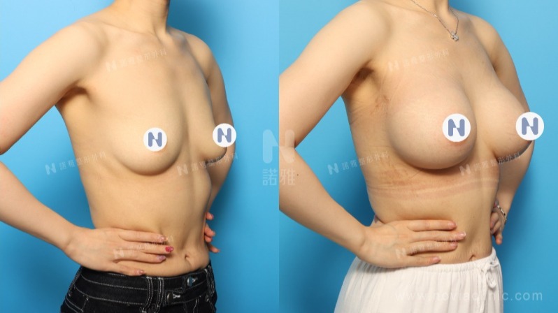 諾雅隆乳手術｜美麗見證案例，手術前後對比照。