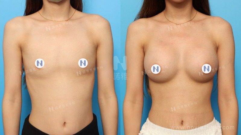諾雅隆乳手術｜隆乳的優點，內視鏡隆乳手術前後對比照。