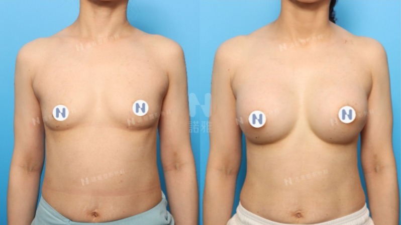 諾雅隆乳手術｜美麗見證案例，手術前後對比照。