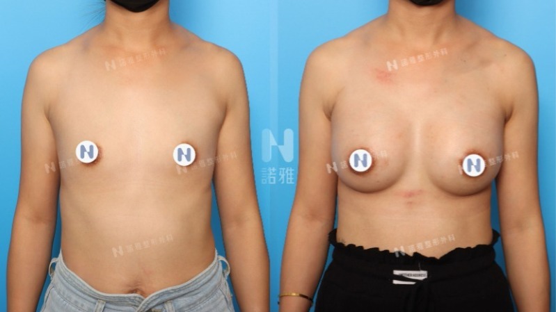 諾雅隆乳手術｜隆乳的優點，內視鏡隆乳手術前後對比照。