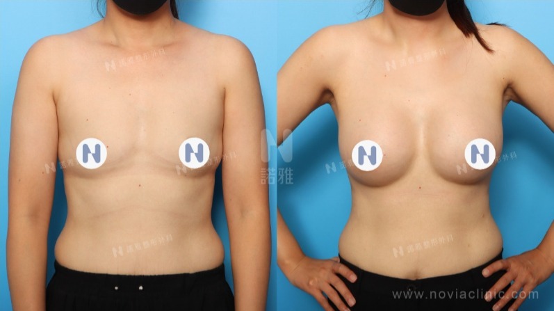 諾雅隆乳手術｜美麗見證案例，手術前後對比照。