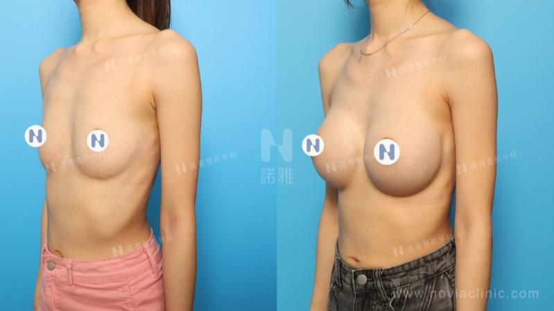 諾雅隆乳手術｜美麗見證案例，手術前後對比照。