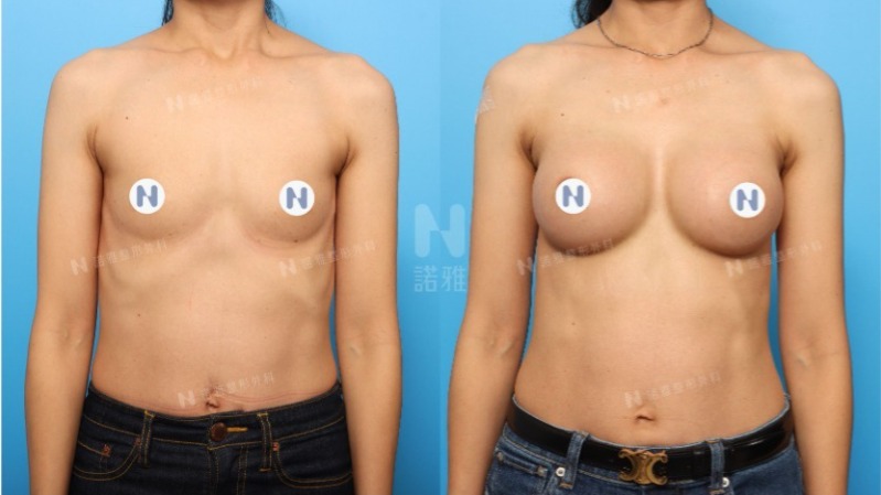 諾雅隆乳手術｜隆乳原理介紹，內視鏡隆乳案例，手術前後對比照。