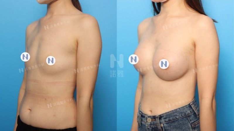諾雅隆乳手術｜隆乳的優點，內視鏡隆乳手術前後對比照。