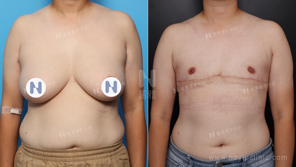 一字型平胸手術案例