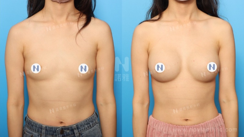 諾雅隆乳手術｜美麗見證案例，手術前後對比照。