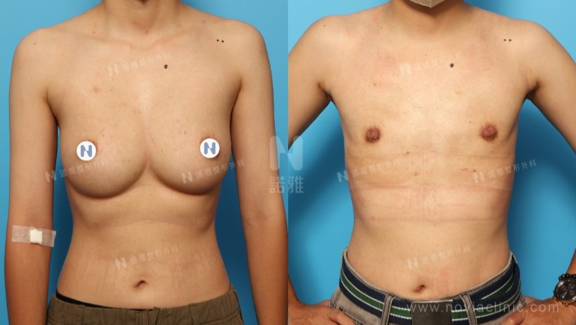 電漿刀微創平胸手術術前術後比較