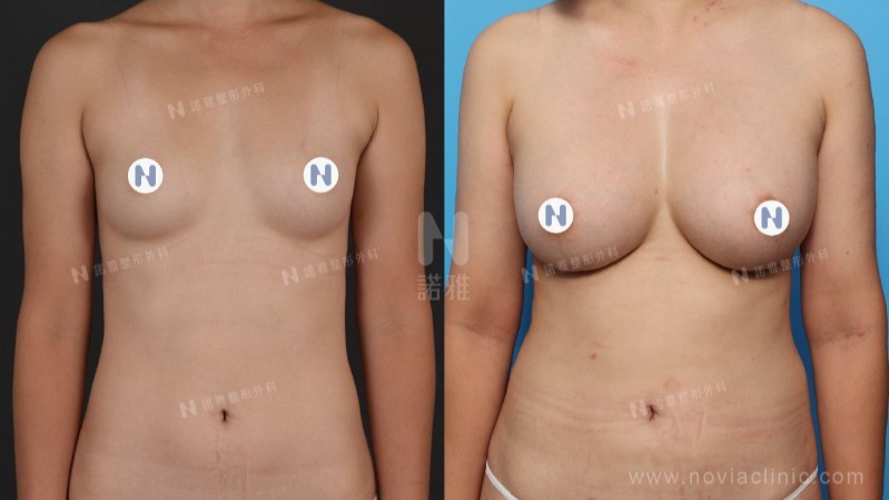 自體脂肪隆乳術前術後比較