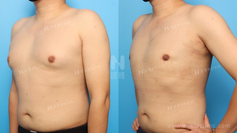 男性女乳手術新進展
