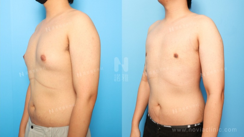 男性女乳手術新進展