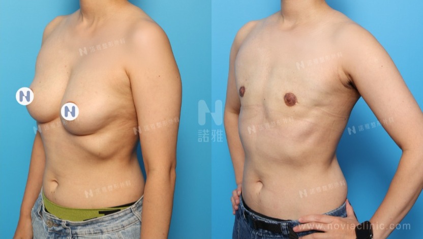 電漿刀微創平胸手術術前術後對比