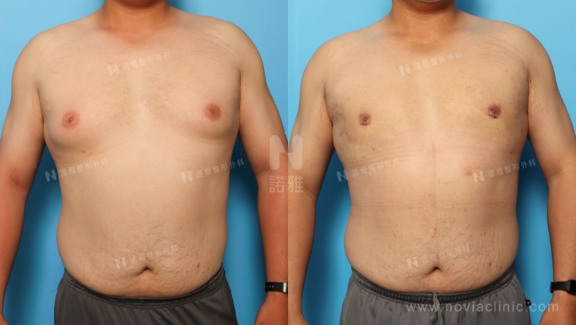 男性女乳症的診斷與手術指南