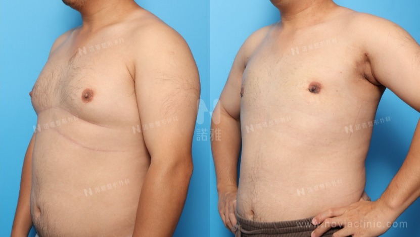 男性女乳症的診斷與手術指南