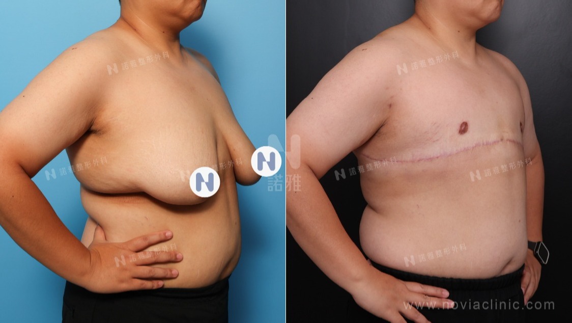一字型平胸手術案例