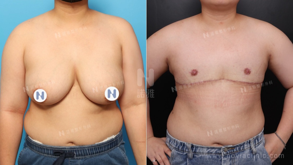一字型平胸手術案例