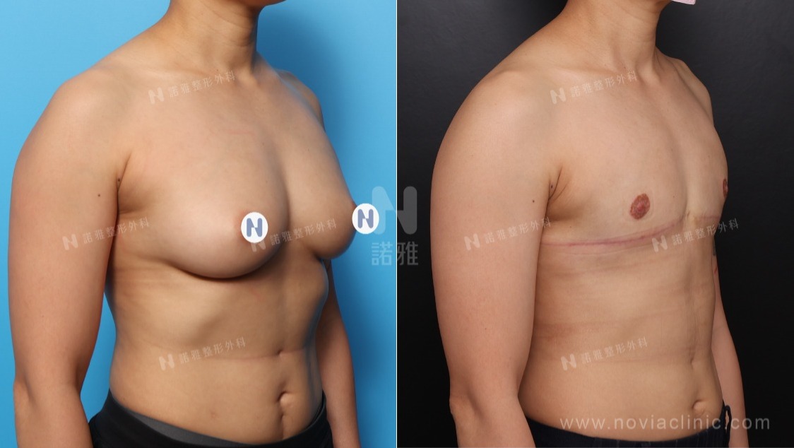 一字型平胸手術案例