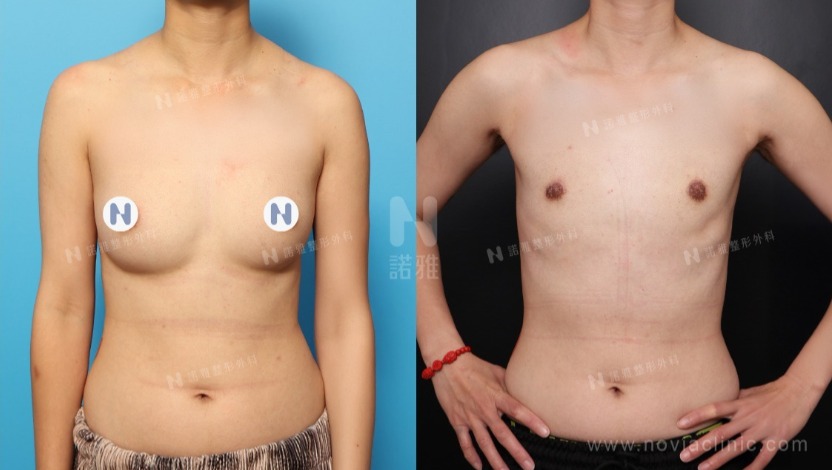 電漿刀微創平胸手術術前術後
