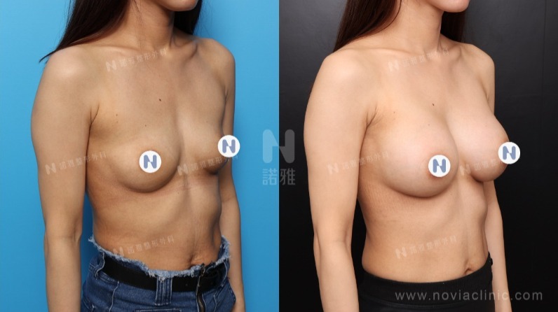 諾雅隆乳手術|隆乳原理介紹,內視鏡隆乳案例,手術前後對比照。