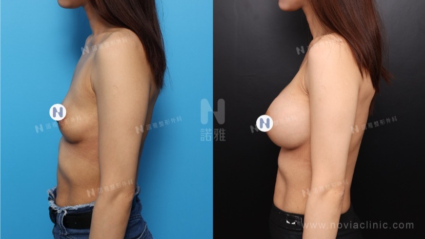 諾雅魔滴隆乳手術美麗見證案例