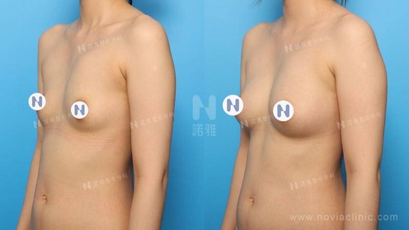 自體脂肪隆乳術後對比圖