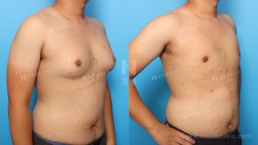 男性女乳症手術推薦