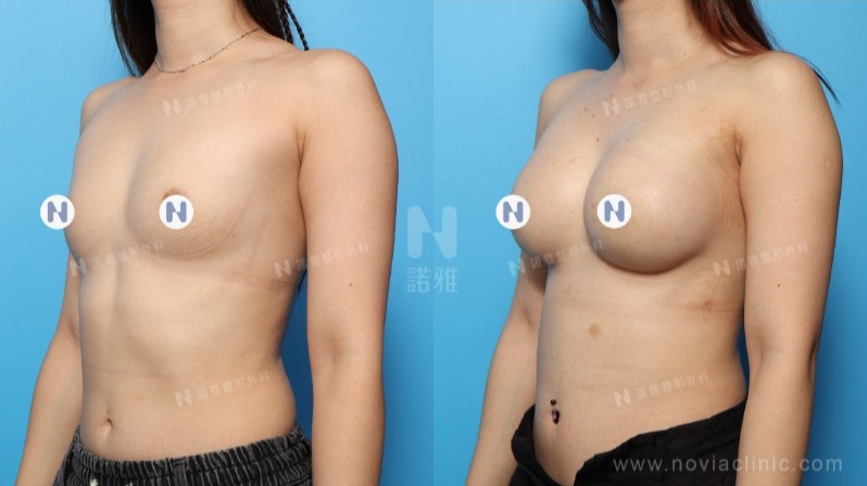 諾雅隆乳手術|美麗見證案例,手術前後對比照。
