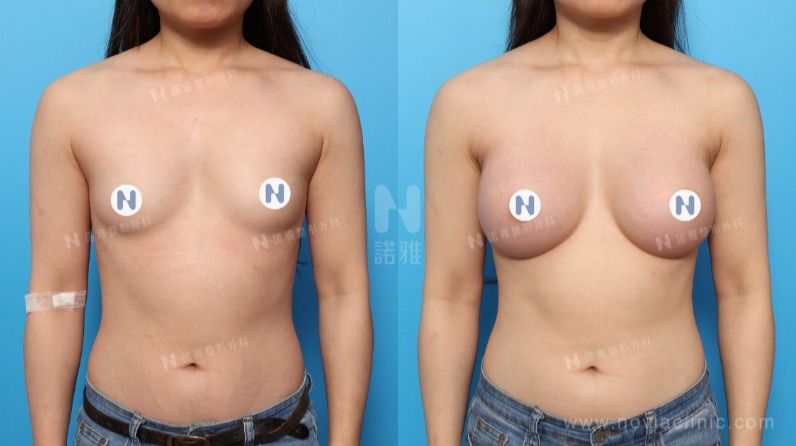 諾雅隆乳手術|隆乳的優點,內視鏡隆乳手術前後對比照。