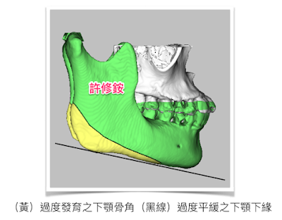 許修銨醫師削骨手術3D模擬示意圖