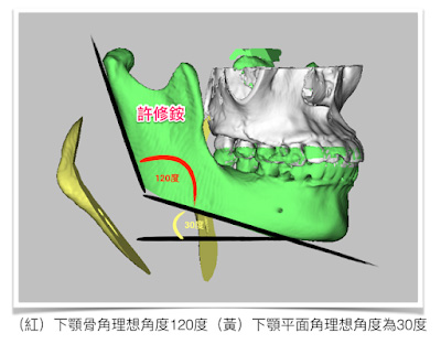 許修銨醫師削骨手術3D模擬示意圖