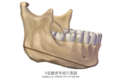 V臉削骨手術示意圖