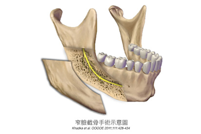 窄臉截骨手術示意圖
